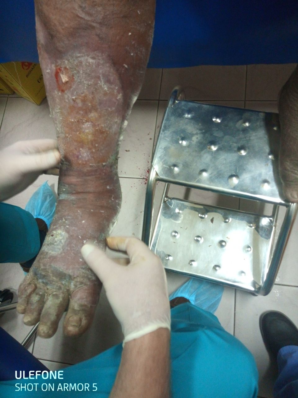 For Physicians | Thermal Decomprssion Mask